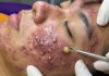 Big Cystic Blackheads Extraction Whiteheads