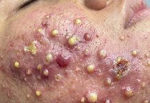 Acne Blackheads Extraction Whiteheads