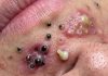 Blackheads Extraction Whiteheads