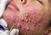 Acne Blackheads Extraction Whiteheads