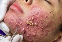 Acne Blackheads Extraction Whiteheads