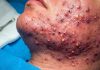 Acne Blackheads Extraction