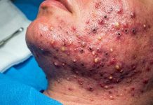 Acne Blackheads Extraction