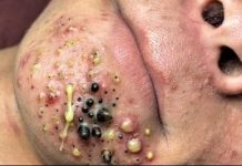 Blackheads Extraction