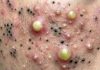 Big Cystic Extraction Whiteheads