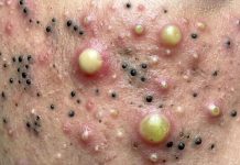 Big Cystic Extraction Whiteheads