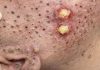Big Cystic Blackheads Extraction Whiteheads