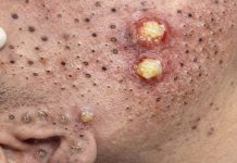 Big Cystic Blackheads Extraction Whiteheads