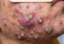 Acne Blackheads Extraction Whiteheads