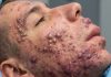 Blackheads Extraction Whiteheads
