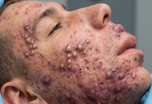 Blackheads Extraction Whiteheads