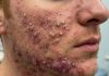 Acne Blackheads Extraction