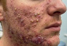 Acne Blackheads Extraction