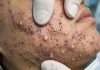 Cystic Acne Blackheads Whiteheads