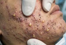 Cystic Acne Blackheads Whiteheads