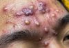 Blackheads Extraction Whiteheads