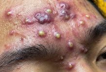 Blackheads Extraction Whiteheads