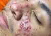 Acne Blackheads Extraction