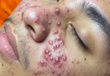 Acne Blackheads Extraction