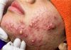 Cystic Blackheads Extraction