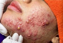 Cystic Blackheads Extraction