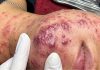 Cystic Acne Blackheads Extraction
