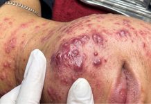 Cystic Acne Blackheads Extraction