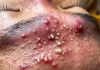 Blackheads Extraction Whiteheads