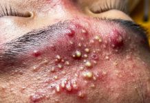 Blackheads Extraction Whiteheads