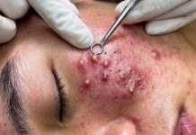 Cystic Acne Blackheads Extraction Removal
