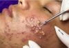 Blackheads Extraction