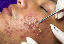 Blackheads Extraction