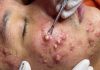 Blackheads Extraction Whiteheads Removal