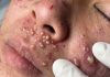 Big Cystic Acne Extraction Whiteheads