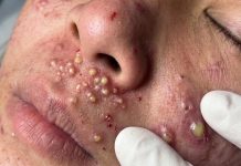 Big Cystic Acne Extraction Whiteheads