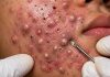 Acne Blackheads Extraction