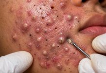 Acne Blackheads Extraction