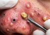Blackheads Extraction Removal