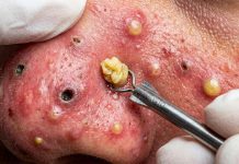 Blackheads Extraction Removal