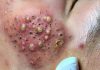 Cystic Acne Blackheads Extraction