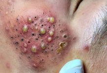 Cystic Acne Blackheads Extraction