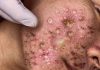 Acne Blackheads Extraction
