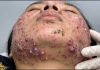 Cystic Blackheads Extraction