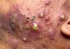 Blackheads Extraction Whiteheads