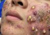Big Cystic Blackheads Extraction Whiteheads