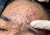 Blackheads Extraction