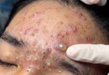 Blackheads Extraction