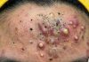 Acne Blackheads Extraction