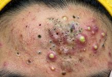 Acne Blackheads Extraction