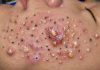Cystic Acne Blackheads Extraction